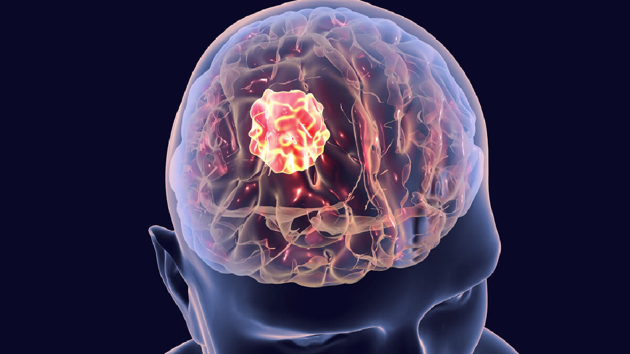 5 أشياء تسبب الإصابة بـ ورم المخ
